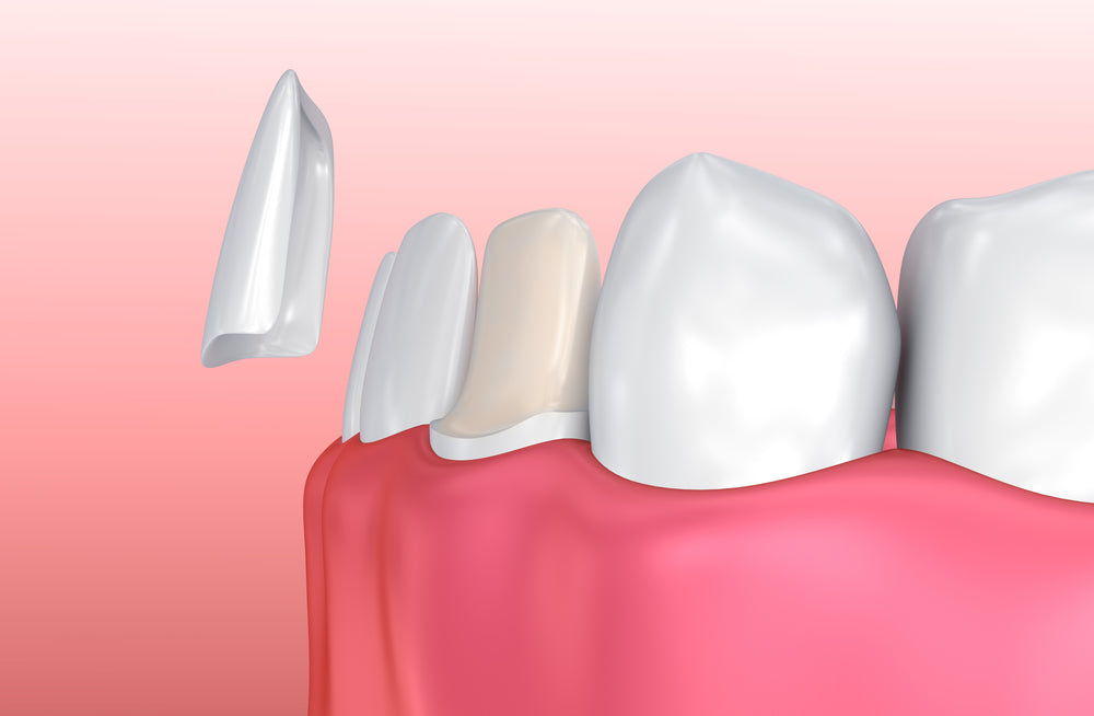 What Is Dental Bonding and What Are the Types?